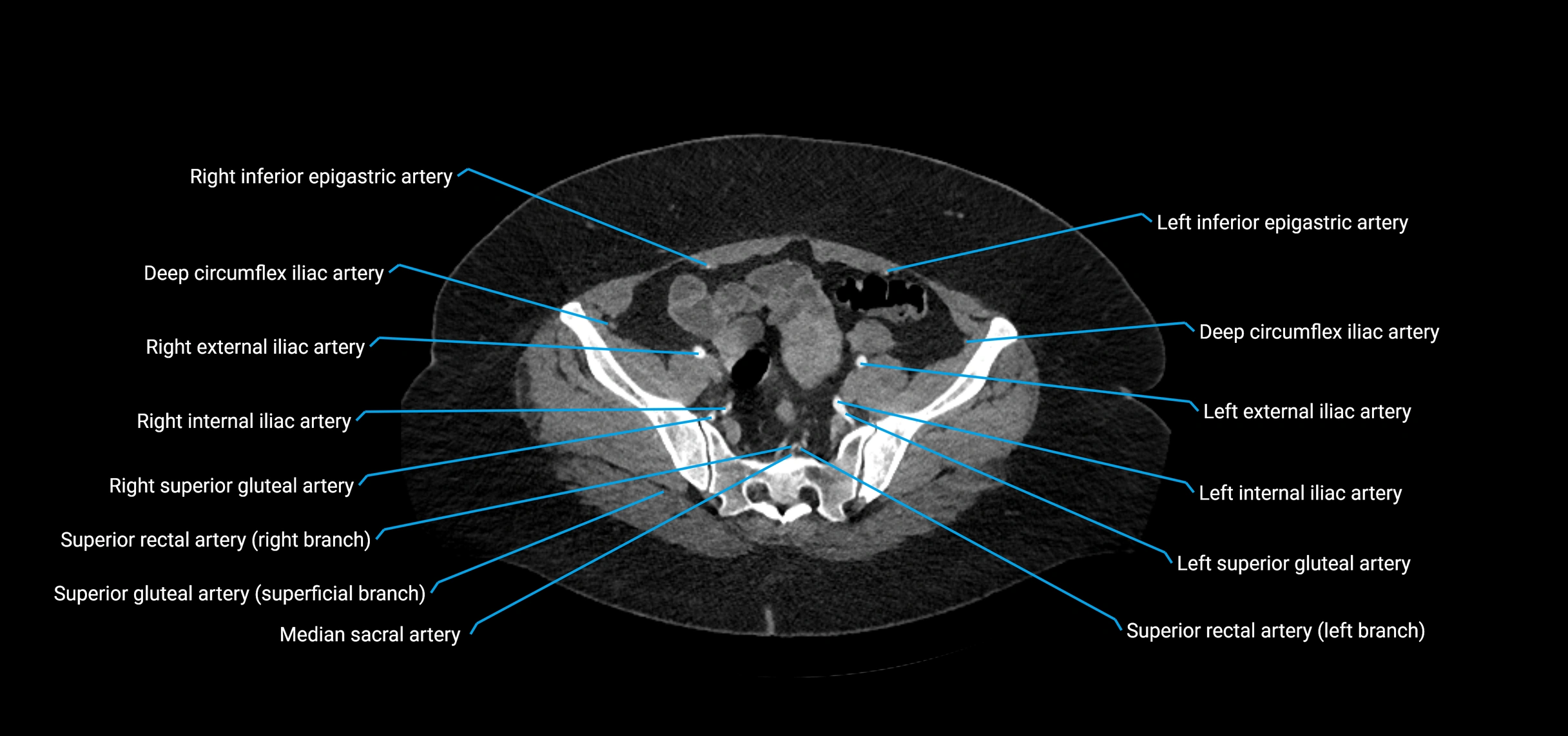 CTA abdomen axial cross sectional anatomy labelled image_201 (2).webp
